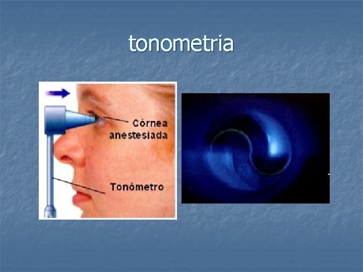 tonometria 