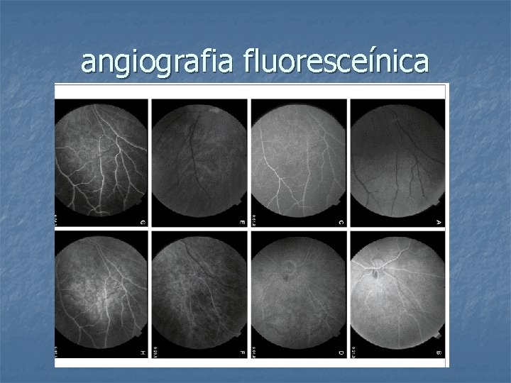 angiografia fluoresceínica 