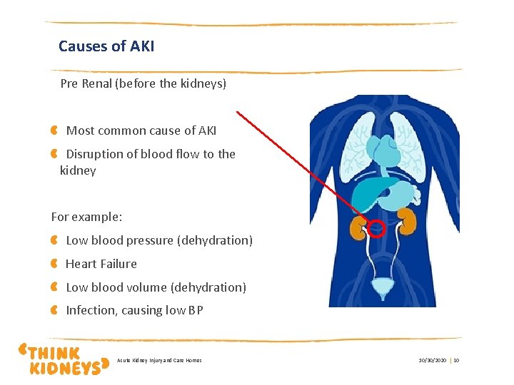 Causes of AKI Pre Renal (before the kidneys) Most common cause of AKI Disruption