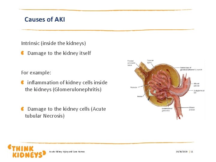 Causes of AKI Intrinsic (inside the kidneys) Damage to the kidney itself For example:
