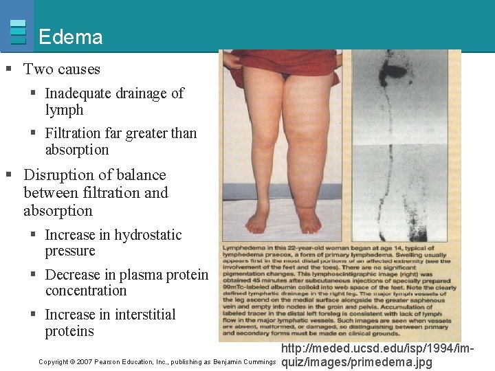 Edema § Two causes § Inadequate drainage of lymph § Filtration far greater than