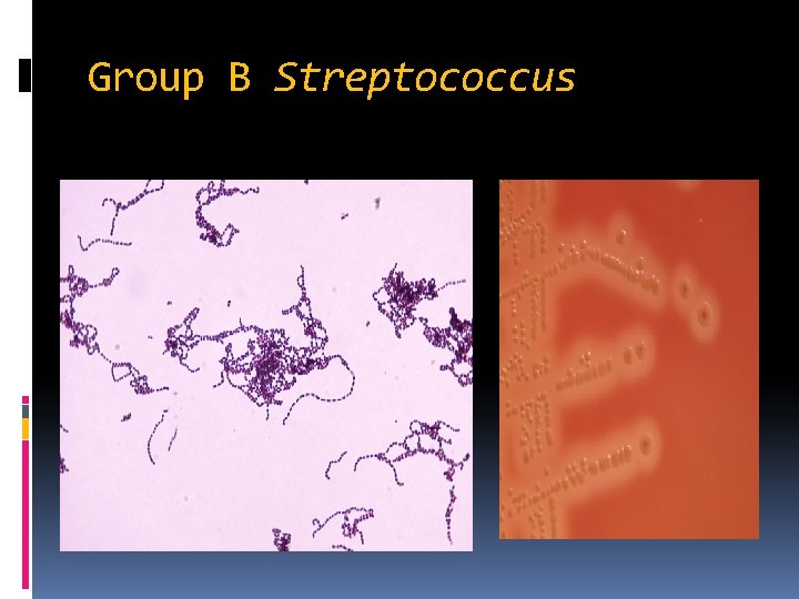 Group B Streptococcus 