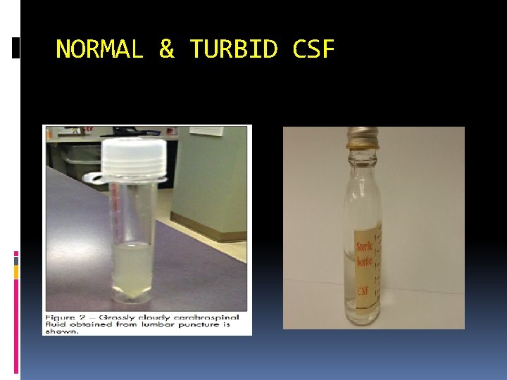 NORMAL & TURBID CSF 