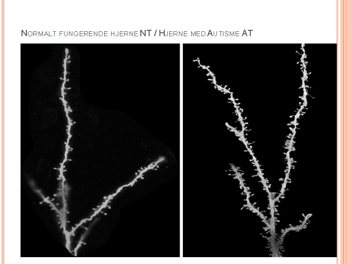 NORMALT FUNGERENDE HJERNE NT / HJERNE MED AUTISME AT 