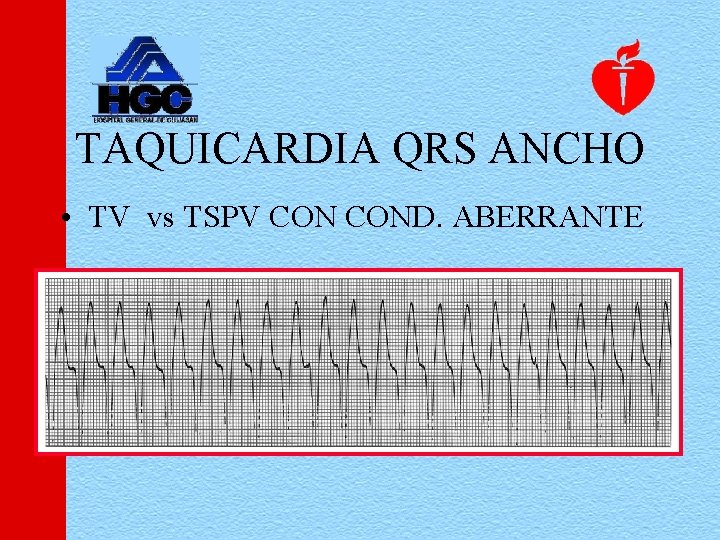 TAQUICARDIA QRS ANCHO • TV vs TSPV COND. ABERRANTE 