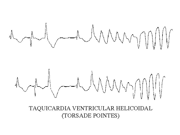 TAQUICARDIA VENTRICULAR HELICOIDAL (TORSADE POINTES) 