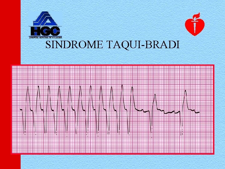 SINDROME TAQUI-BRADI 