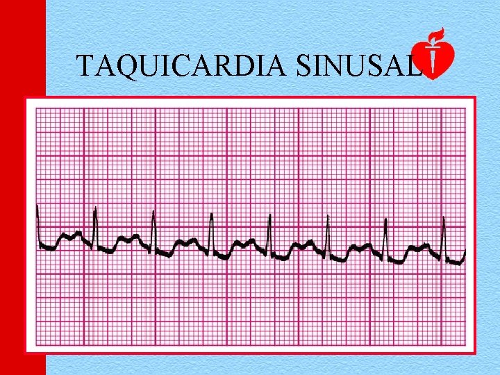 TAQUICARDIA SINUSAL 