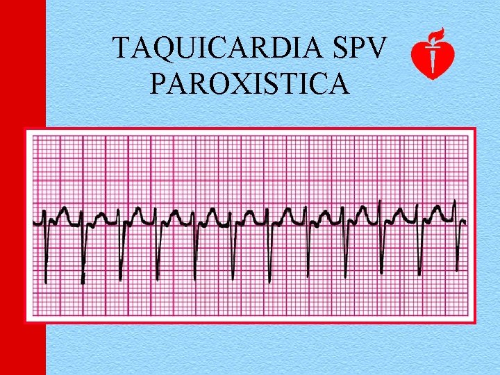 TAQUICARDIA SPV PAROXISTICA 