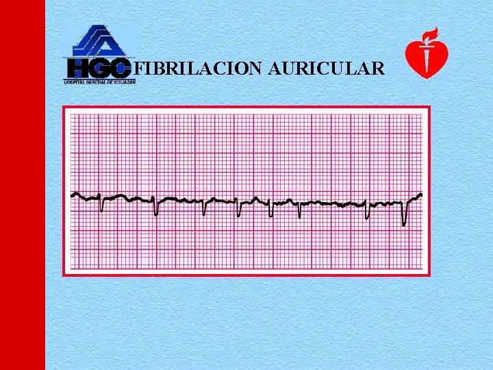 FIBRILACION AURICULAR 