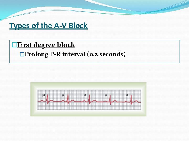 Types of the A-V Block �First degree block �Prolong P-R interval (0. 2 seconds)