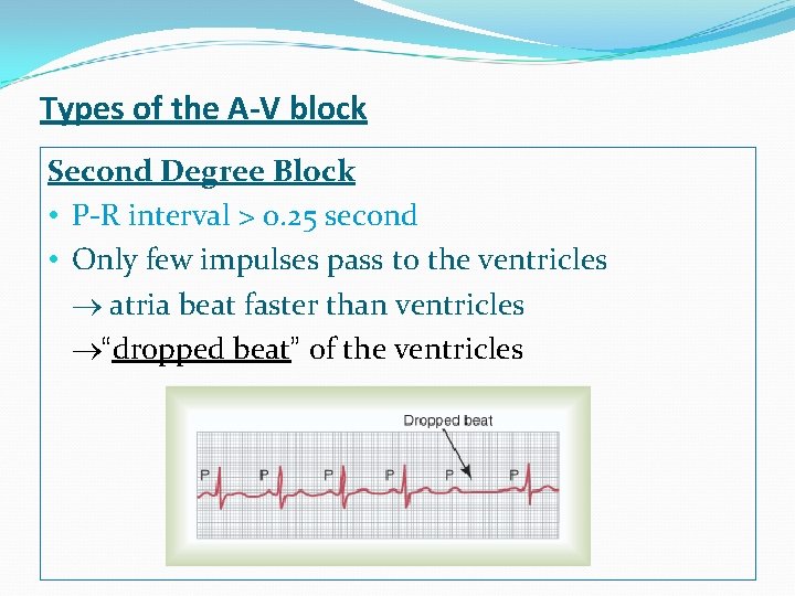 Types of the A-V block Second Degree Block • P-R interval > 0. 25