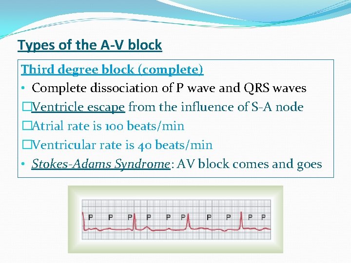 Types of the A-V block Third degree block (complete) • Complete dissociation of P