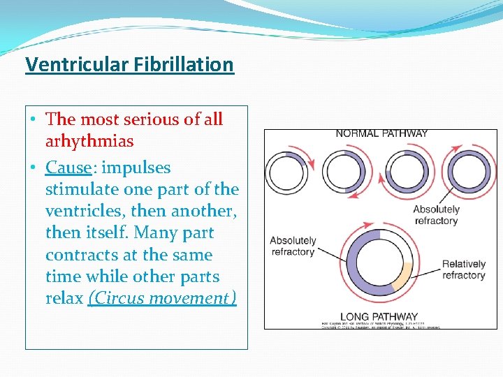 Ventricular Fibrillation • The most serious of all arhythmias • Cause: impulses stimulate one