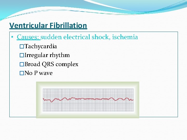 Ventricular Fibrillation • Causes: sudden electrical shock, ischemia �Tachycardia �Irregular rhythm �Broad QRS complex