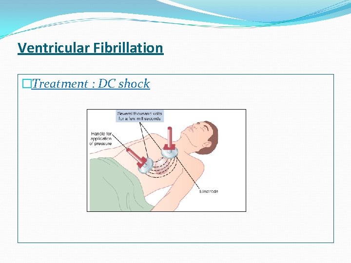 Ventricular Fibrillation �Treatment : DC shock 