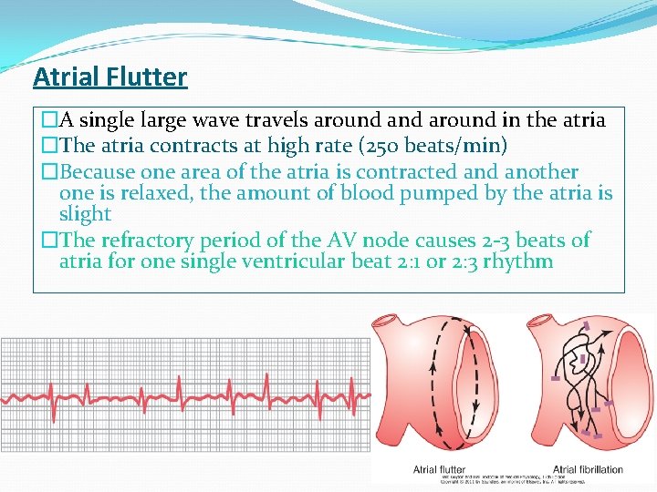 Atrial Flutter �A single large wave travels around in the atria �The atria contracts