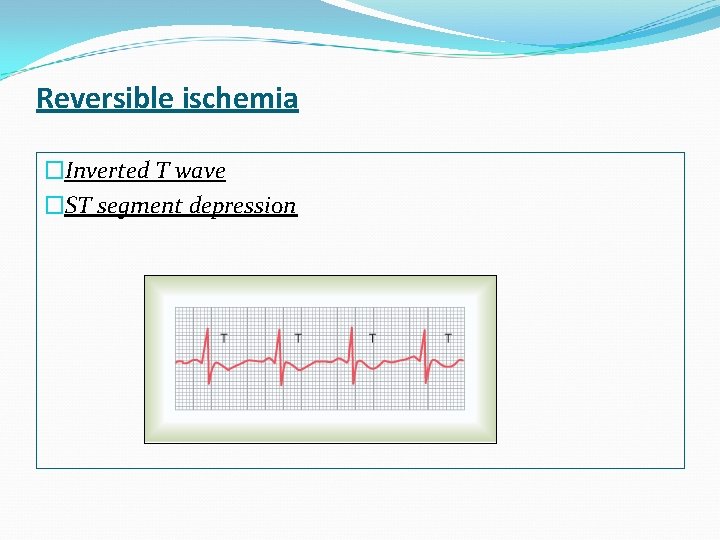 Reversible ischemia �Inverted T wave �ST segment depression 