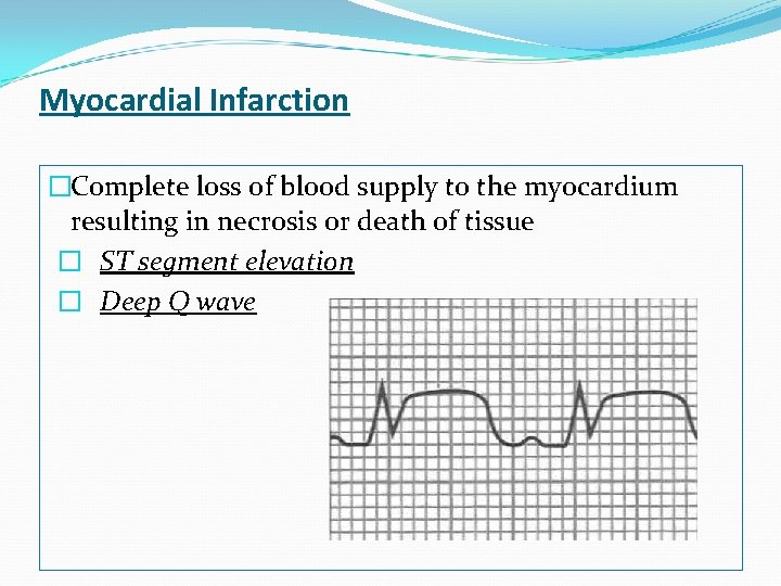 Myocardial Infarction �Complete loss of blood supply to the myocardium resulting in necrosis or