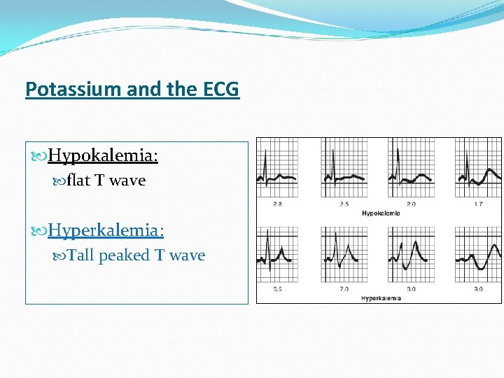 Potassium and the ECG Hypokalemia: flat T wave Hyperkalemia: Tall peaked T wave 