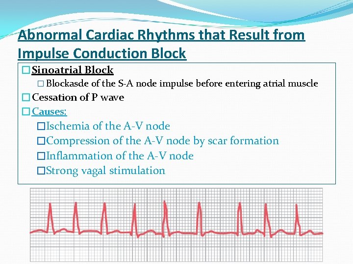 Abnormal Cardiac Rhythms that Result from Impulse Conduction Block �Sinoatrial Block � Blockasde of