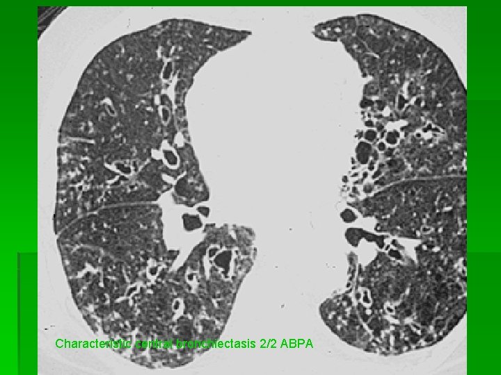 Characteristic central bronchiectasis 2/2 ABPA 