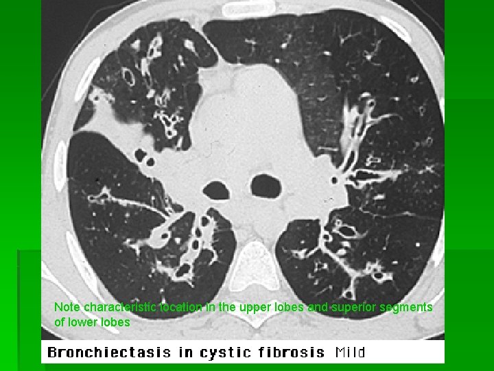 Note characteristic location in the upper lobes and superior segments of lower lobes 