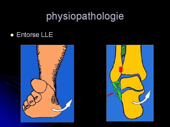 physiopathologie l Entorse LLE 