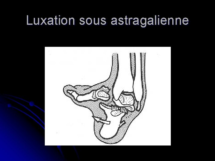 Luxation sous astragalienne 