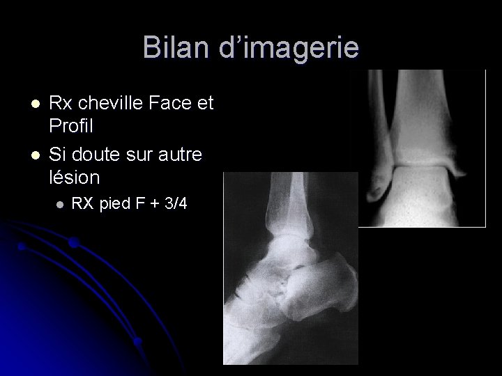 Bilan d’imagerie l l Rx cheville Face et Profil Si doute sur autre lésion