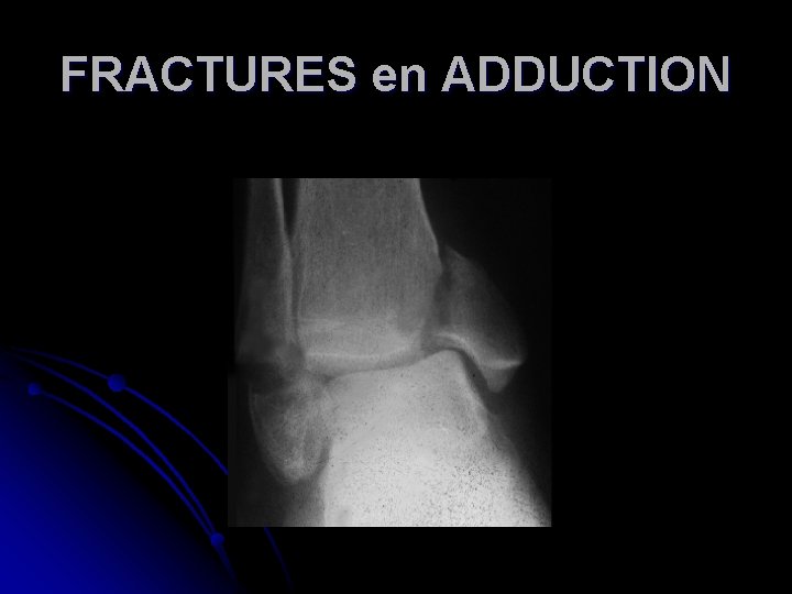 FRACTURES en ADDUCTION 