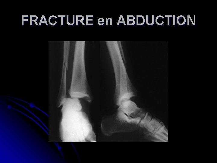 FRACTURE en ABDUCTION 