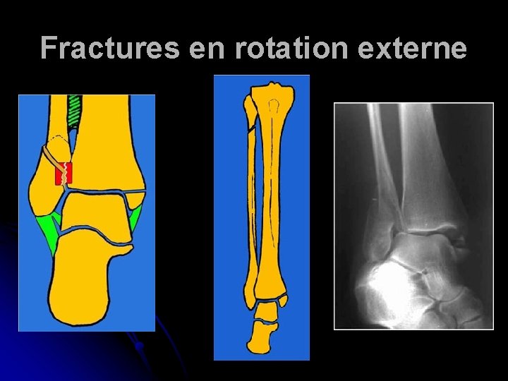 Fractures en rotation externe 