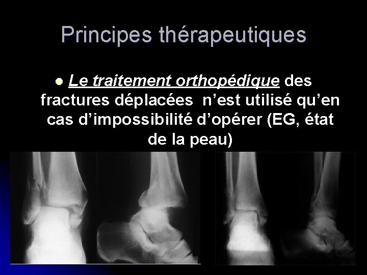 Principes thérapeutiques Le traitement orthopédique des fractures déplacées n’est utilisé qu’en cas d’impossibilité d’opérer