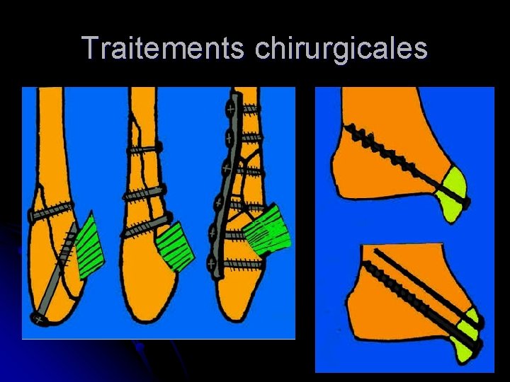 Traitements chirurgicales 