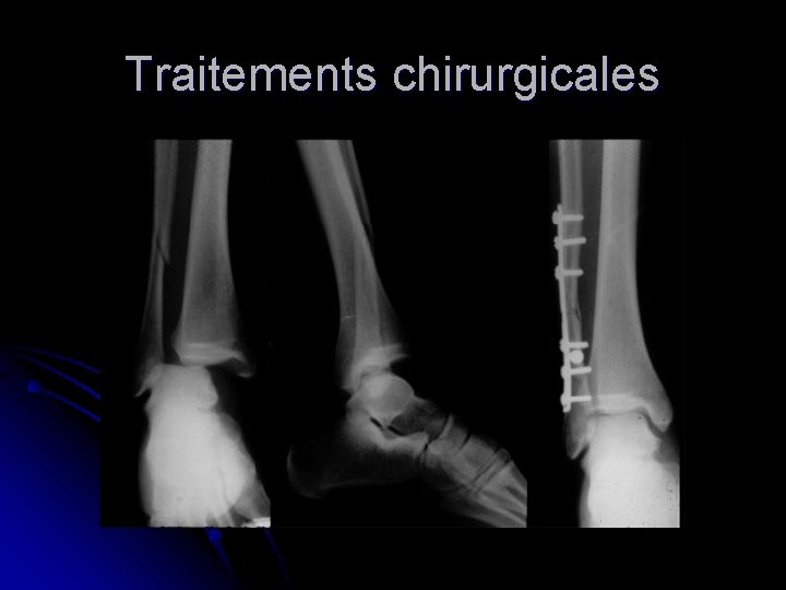 Traitements chirurgicales 
