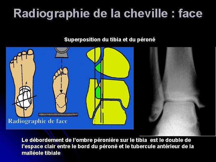 Radiographie de la cheville : face Superposition du tibia et du péroné Le débordement