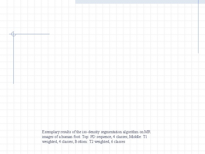 Exemplary results of the iso-density segmentation algorithm on MR images of a human foot: