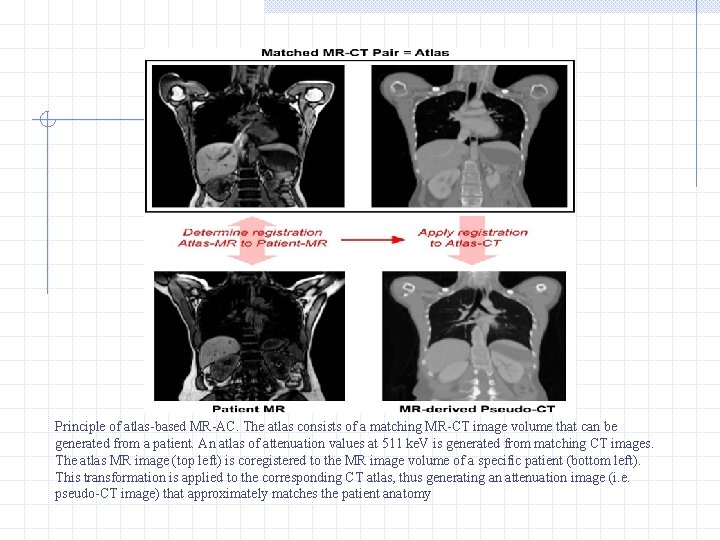 Principle of atlas-based MR-AC. The atlas consists of a matching MR-CT image volume that