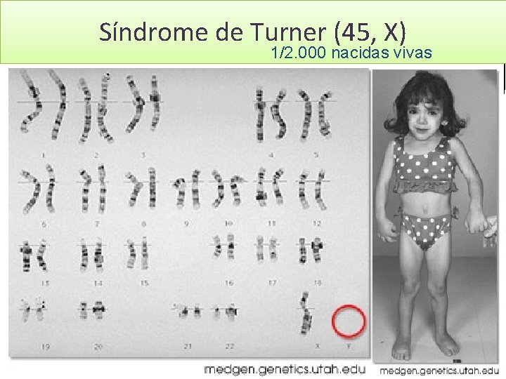 GENÉTICA LEYES DE MENDEL Biología y Geología 4º ESO Síndrome de Turner (45, X)