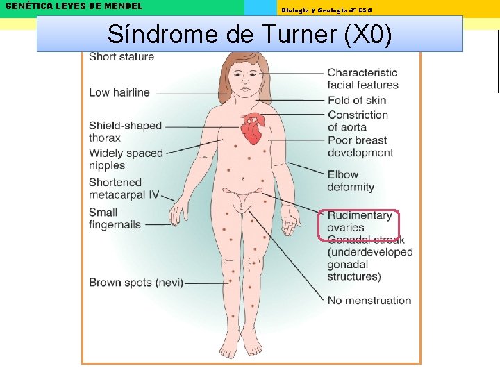 GENÉTICA LEYES DE MENDEL Biología y Geología 4º ESO Síndrome de Turner (X 0)