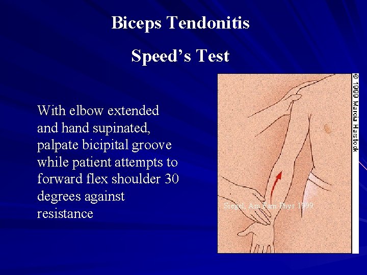 Biceps Tendonitis Speed’s Test With elbow extended and hand supinated, palpate bicipital groove while