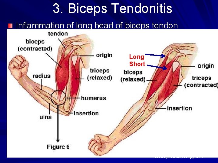 3. Biceps Tendonitis Inflammation of long head of biceps tendon Repetitive lifting, overhead reaching