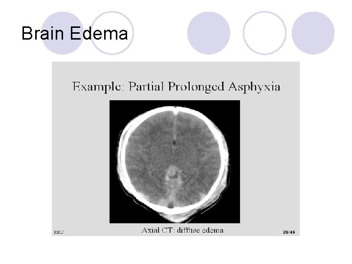 Brain Edema 