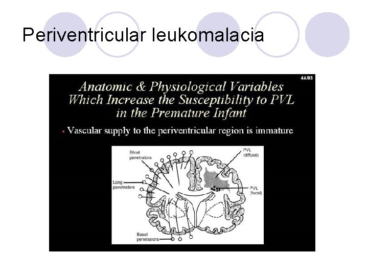 Periventricular leukomalacia 