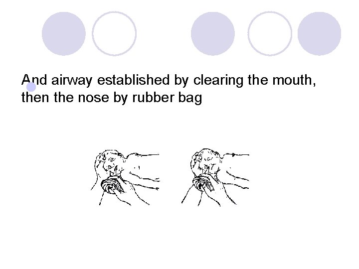 And airway established by clearing the mouth, l then the nose by rubber bag