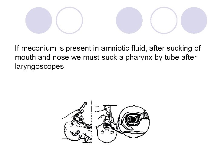 If meconium is present in amniotic fluid, after sucking of mouth and nose we