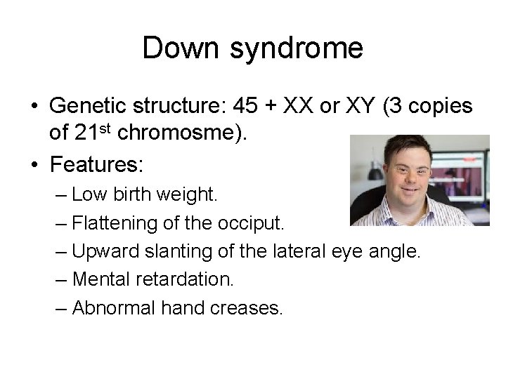 Down syndrome • Genetic structure: 45 + XX or XY (3 copies of 21