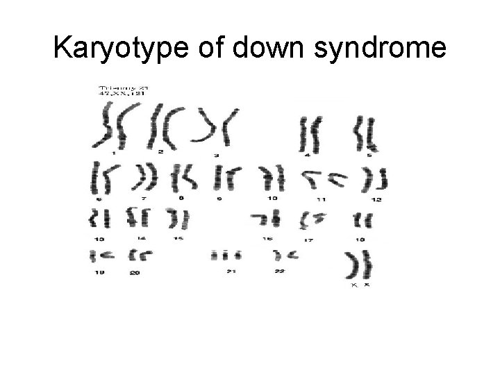 Karyotype of down syndrome 