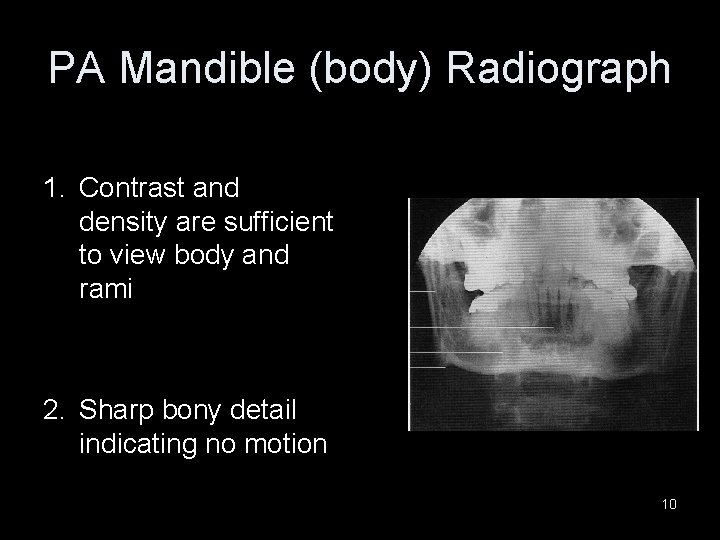 PA Mandible (body) Radiograph 1. Contrast and density are sufficient to view body and